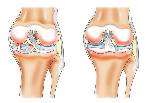 osteoartritis koljena tretira s medom)