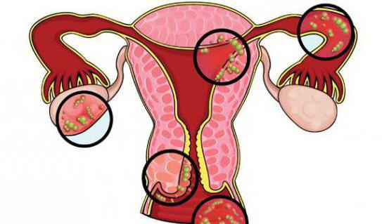 Қынап ісіктерінің суреттері Қынап ісіктерінің суреттері