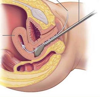 Suspiciunea de polip endometrial Tag: histeroscopie