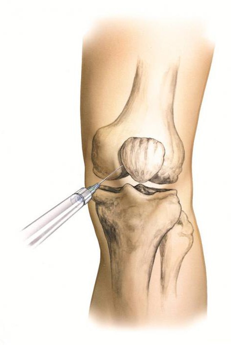 artroza metatarsofalangealnog zgloba 3 stupnja