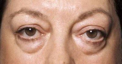 hogyan lehet eltávolítani a szem alatti zsírt