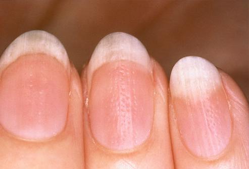 begrænse brutalt Forstyrret Ujævne negle på hænderne: Grunden til behandlingen
