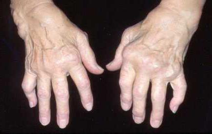 masti i gelovi za liječenje artroze zglobova