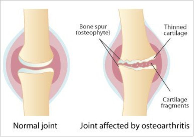 vijesti za artroze tretman briga za bol u zglobovima