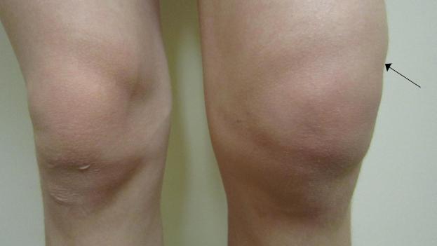 Metode liječenja artroze koljena