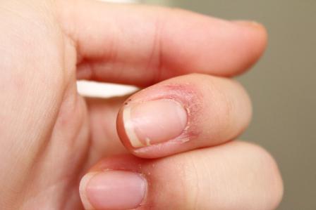 hogyan kell gyógyítani a gomba az ujjakon a köröm