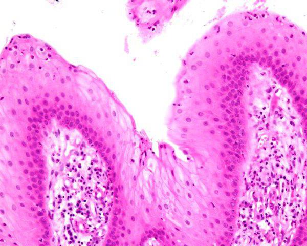 Anormal klitoris fotosuratlari