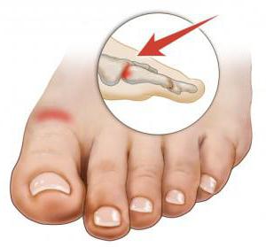 artritis tretmana stopala zajedničkom liječenje boli u zglobovima senfom