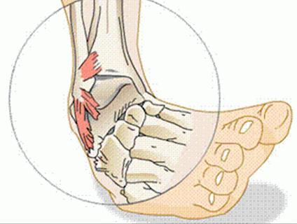 伤害 脚踝韧带 踝关节韧带损伤 症状 治疗 后果