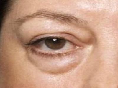 Pattanás a szem fölött a felső szemhéjon: lehetséges okok, kezelés, megelőzés, fénykép