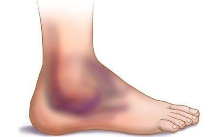 ogorčena noge artroze tretman posttraumatska artroza i njezino liječenje
