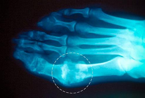 Bunions: punca, gejala dan rawatan