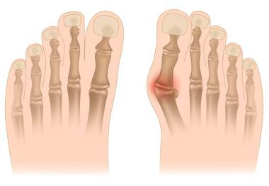 artroza zgloba koljena prognoza simptomi liječenja bol u kuku kad se nagne