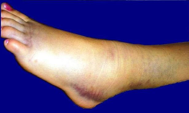 ogorčena noge artroze tretman kvantna terapija u liječenju artroze