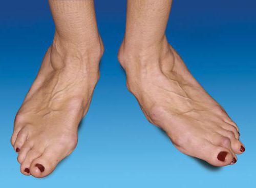 učinkovit tretman za artrozu stopala